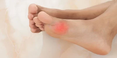 ایجاد التهاب، سوزش و تاول‌های دردناک-